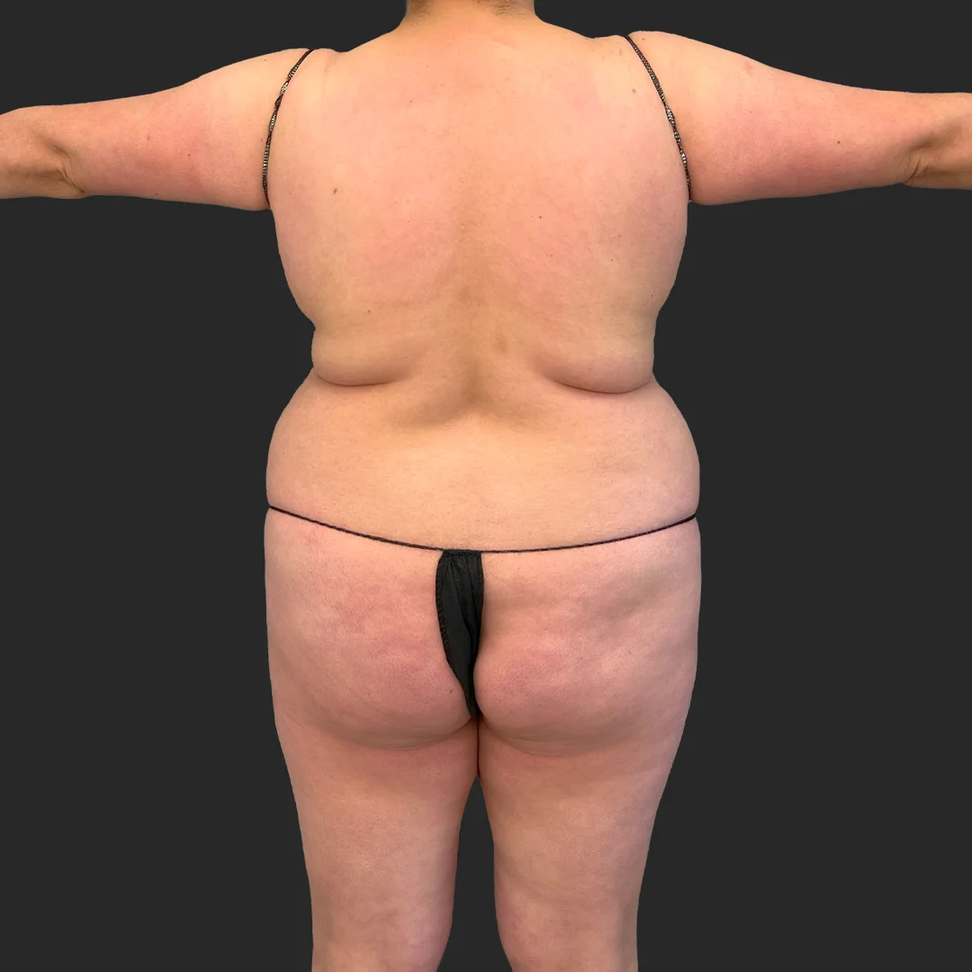Bbl before and after - before
