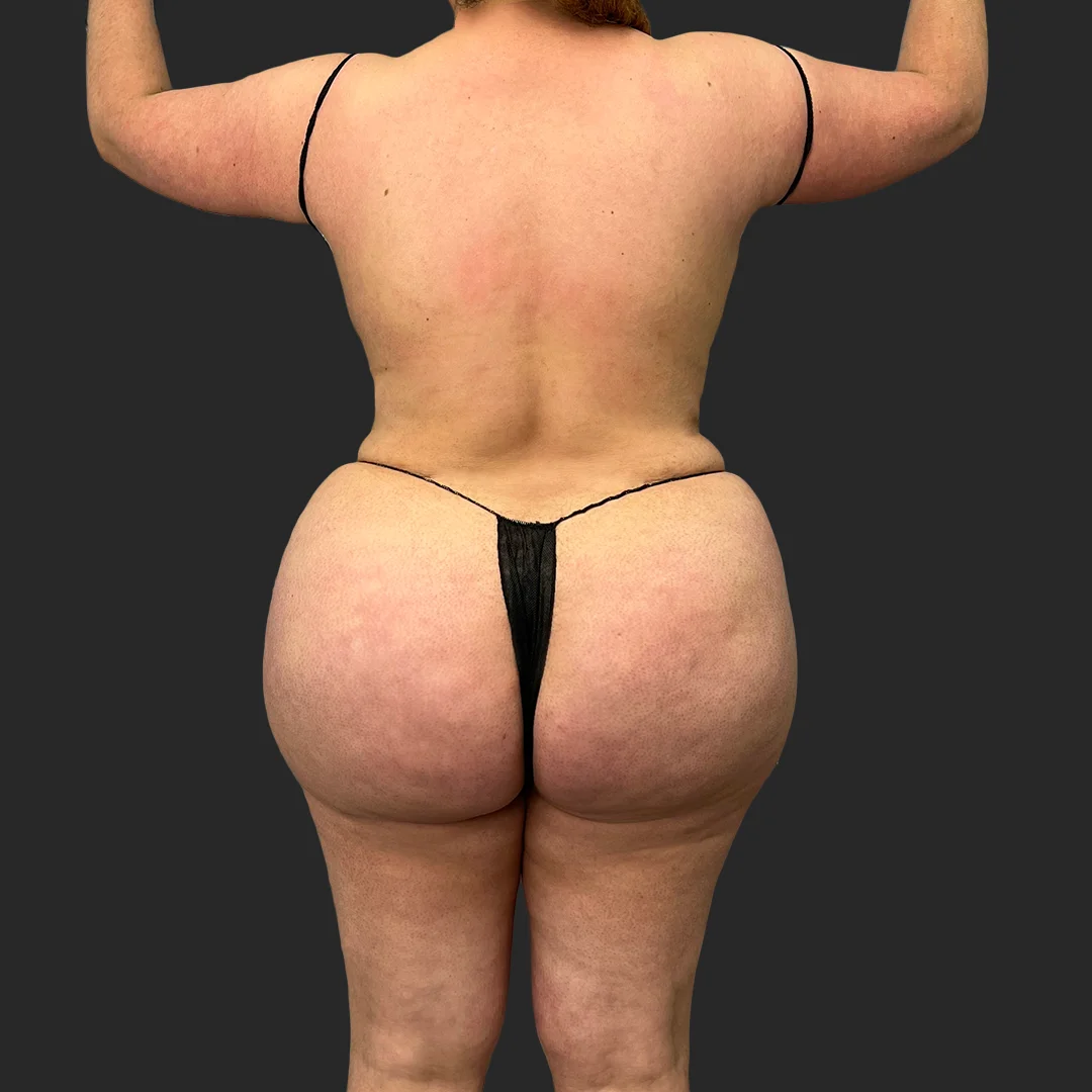 Bbl before and after - after