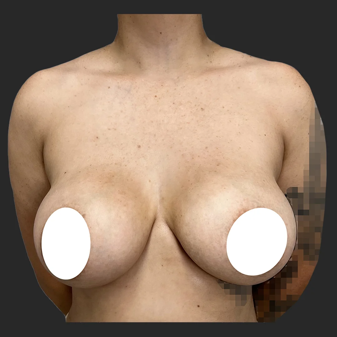 Procedure before and after - before
