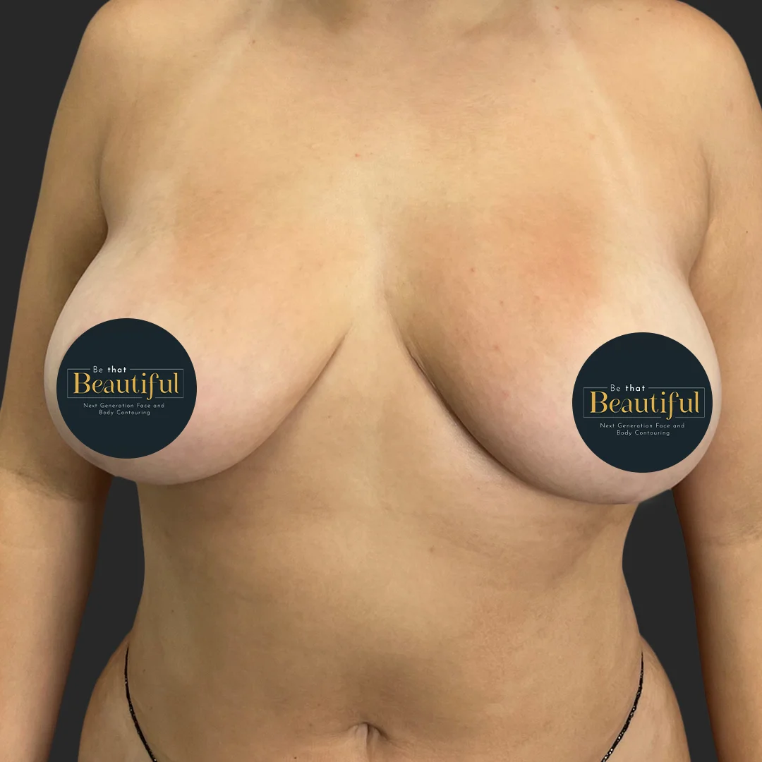 Procedure before and after - after