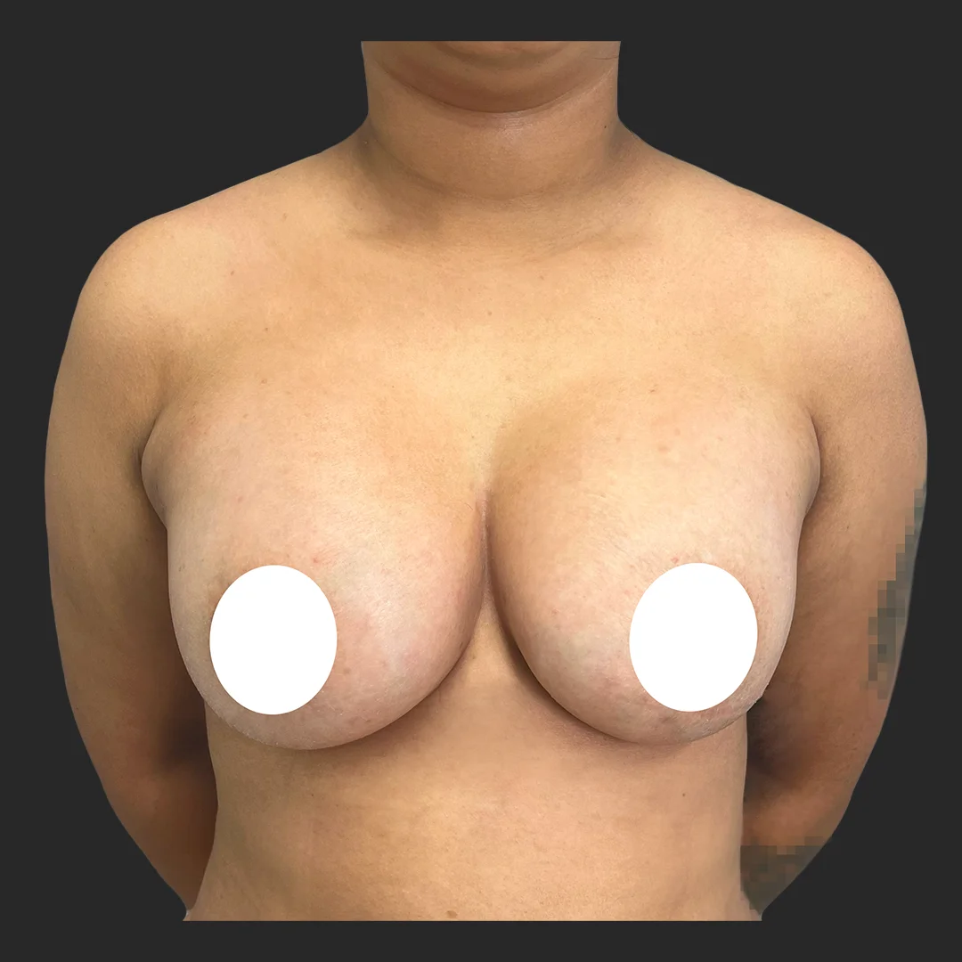 Procedure before and after - after