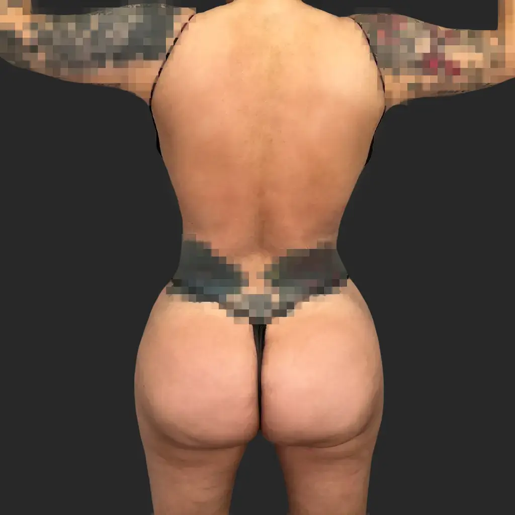 Procedure before and after - after