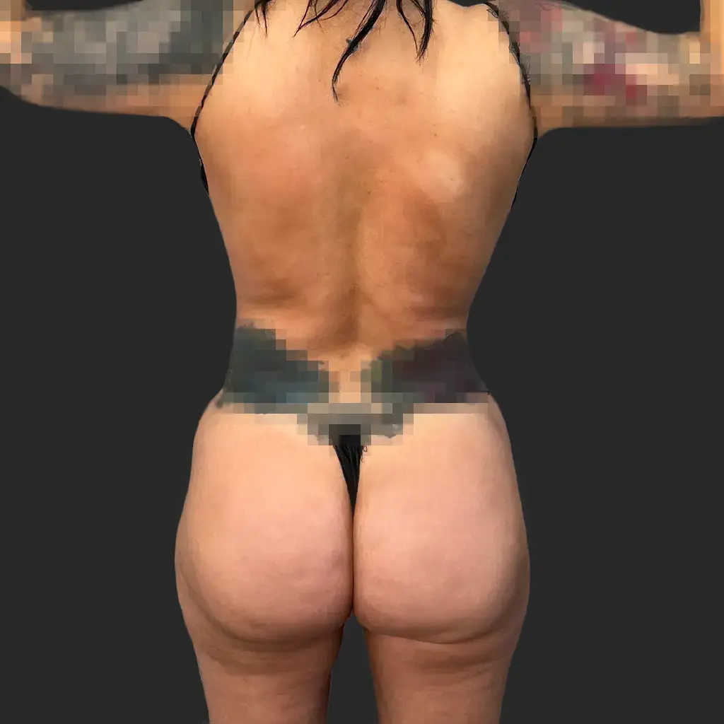Procedure before and after - before
