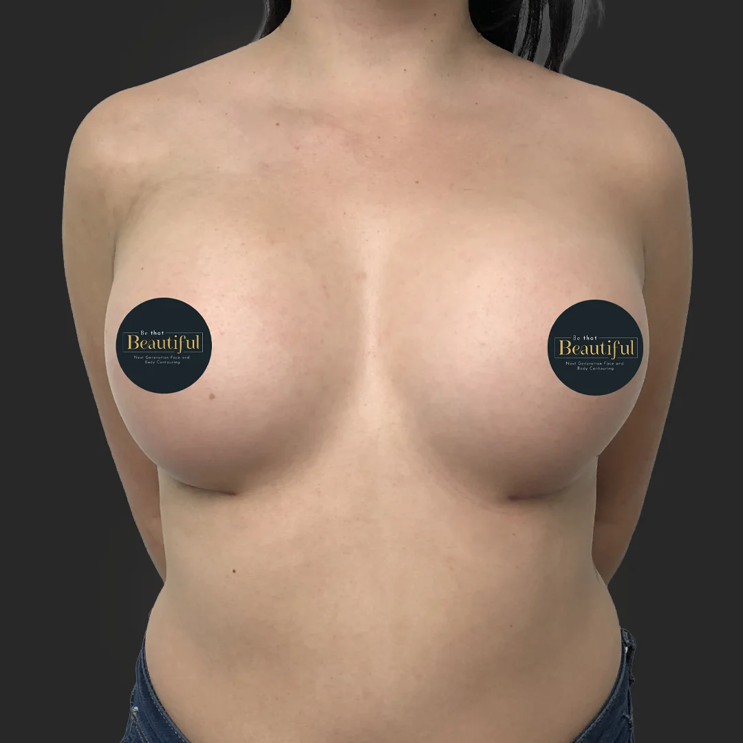 Procedure before and after - after