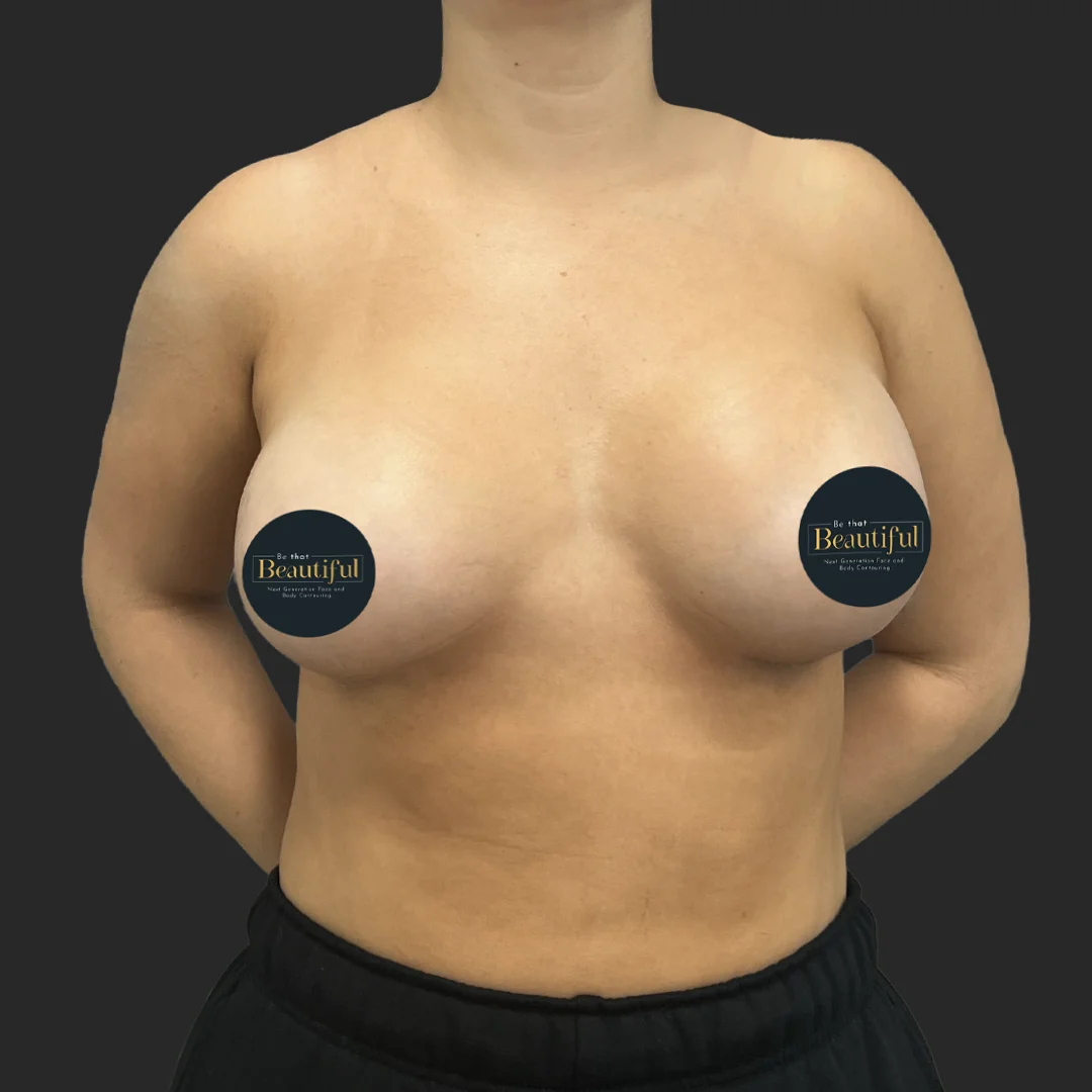 Procedure before and after - after