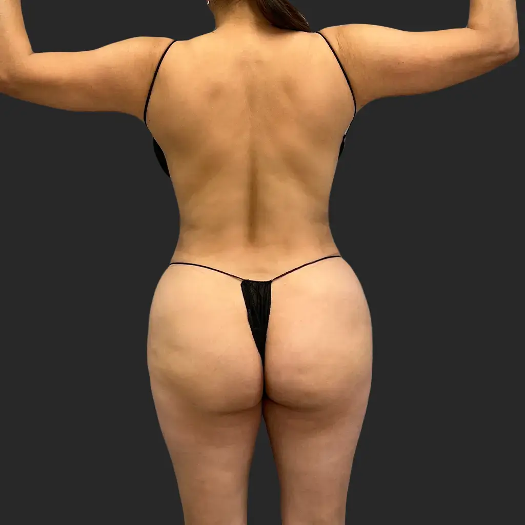 Tummy Tuck before and after - after