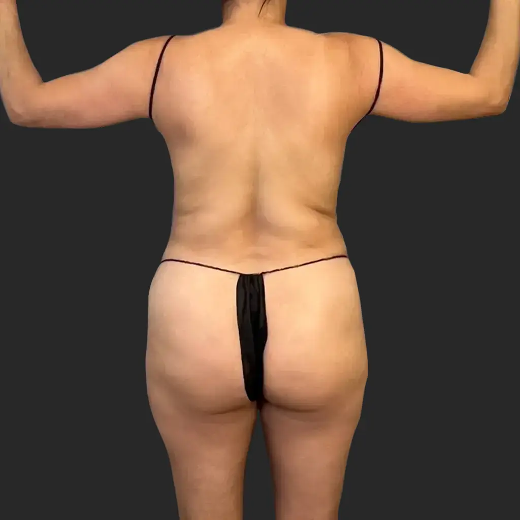 Tummy Tuck before and after - before