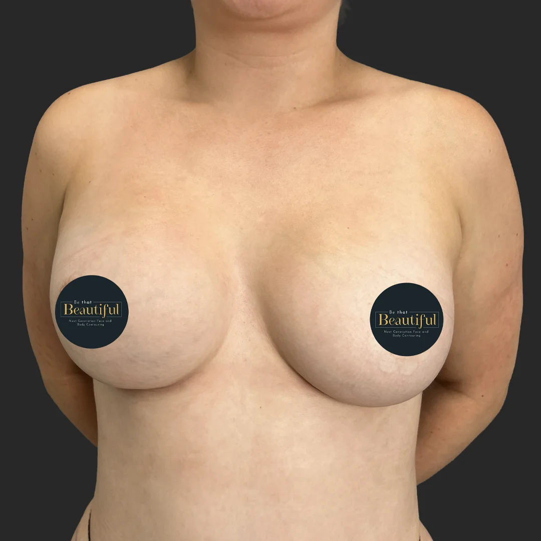Procedure before and after - after