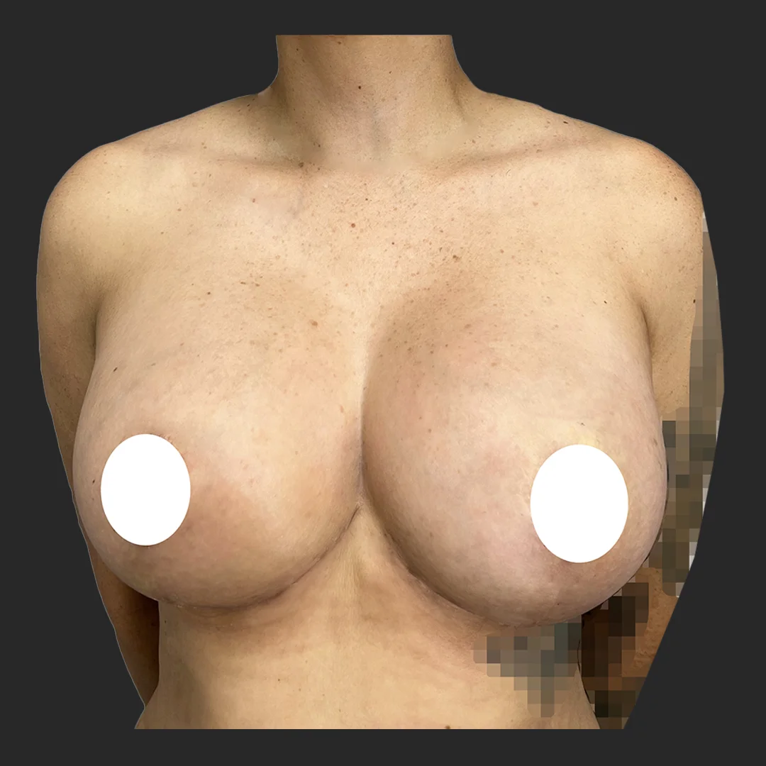 Procedure before and after - after