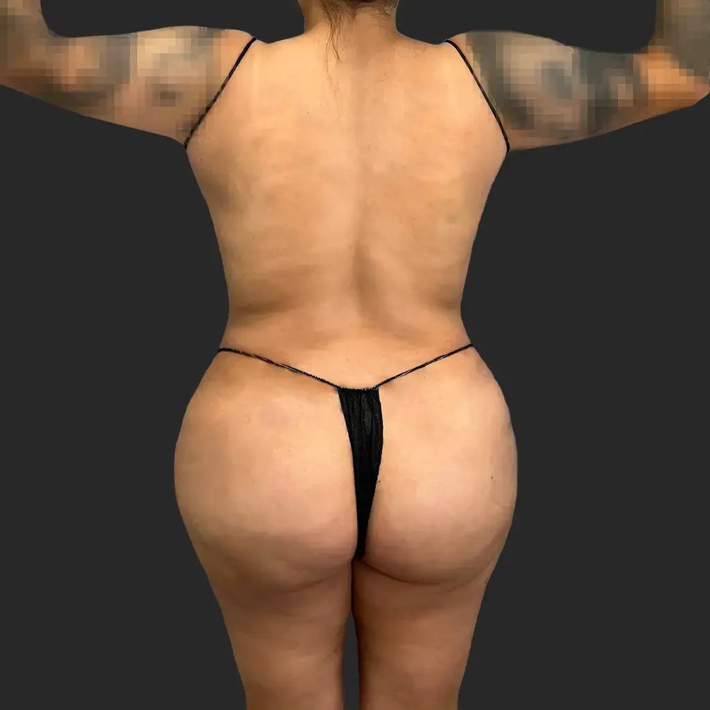Procedure before and after - after