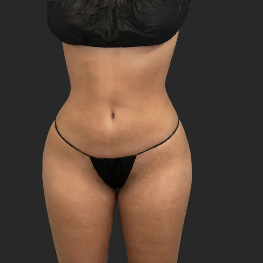Procedure before and after - after
