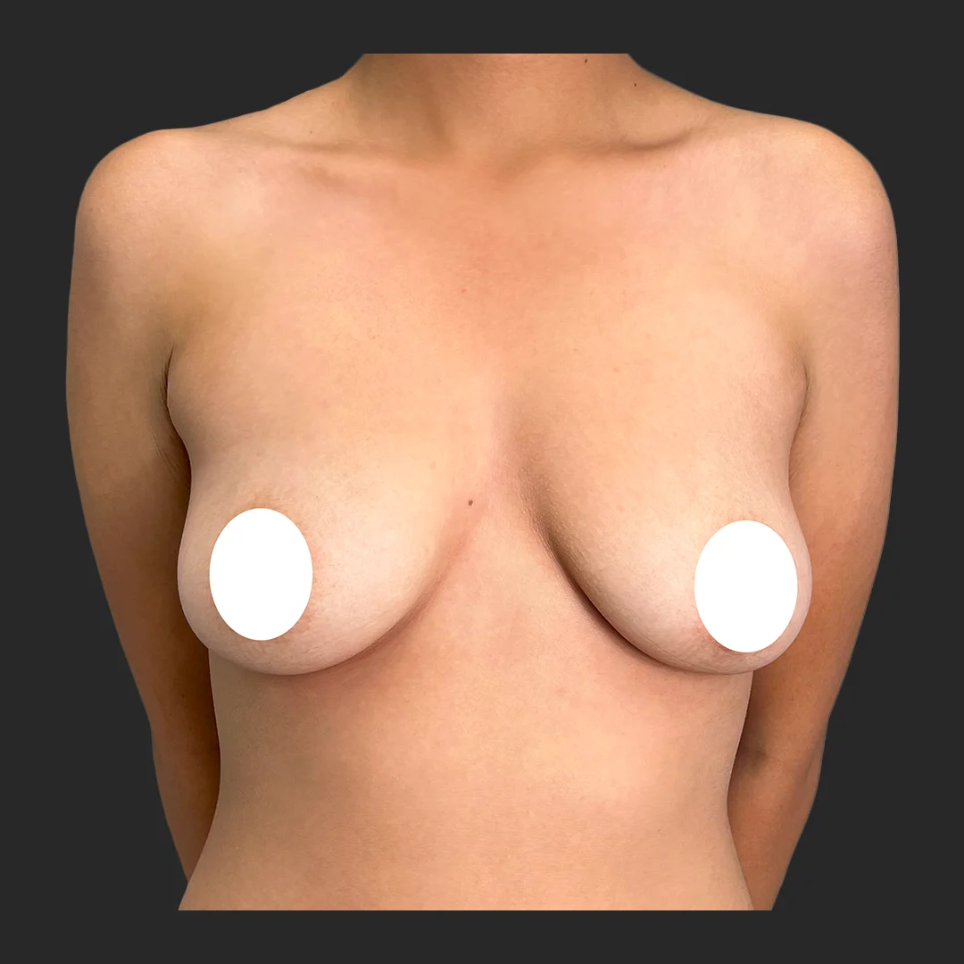 Procedure before and after - before