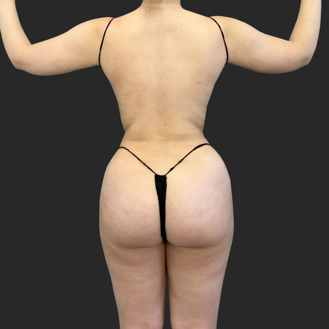 Tummy Tuck before and after - after