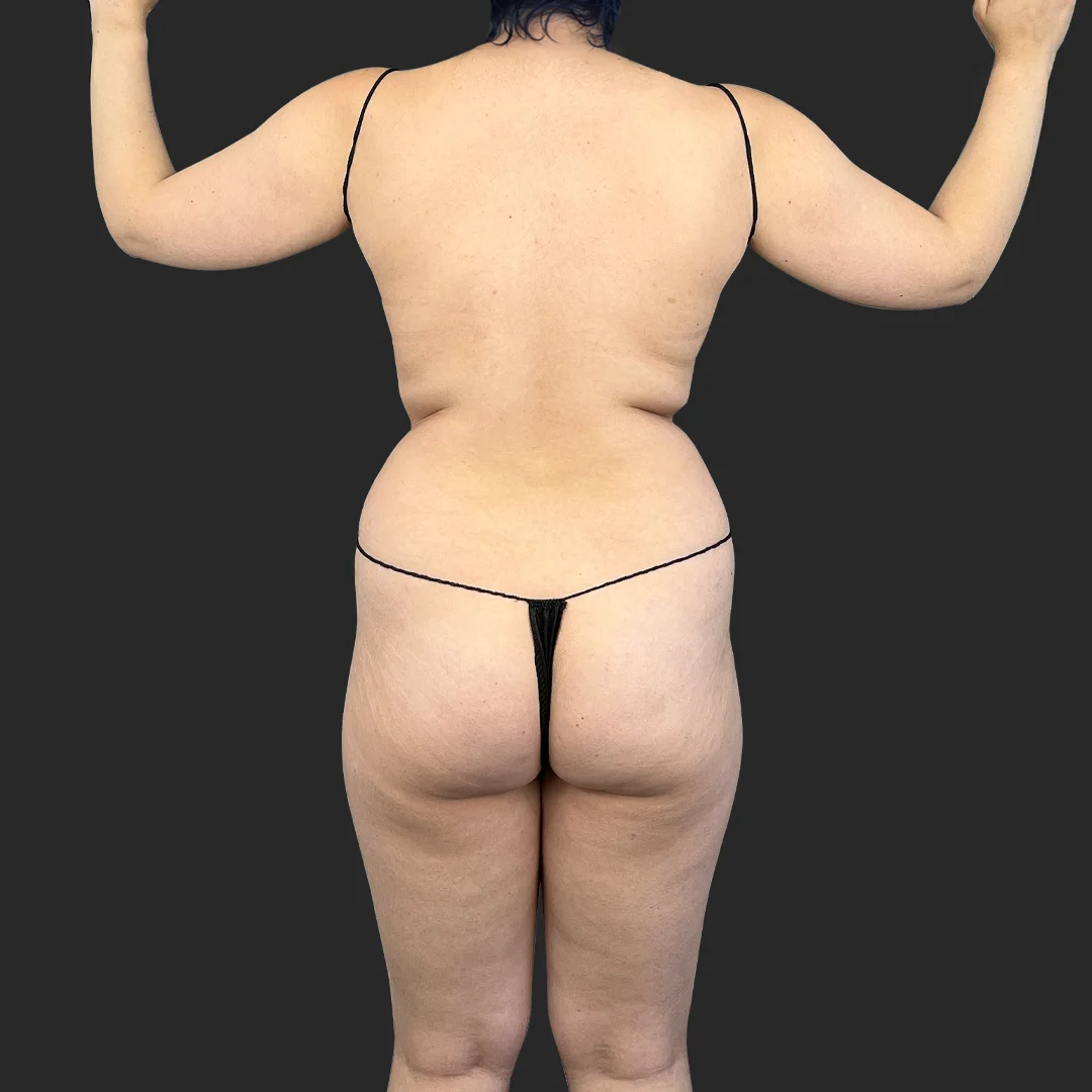 Tummy Tuck before and after - before