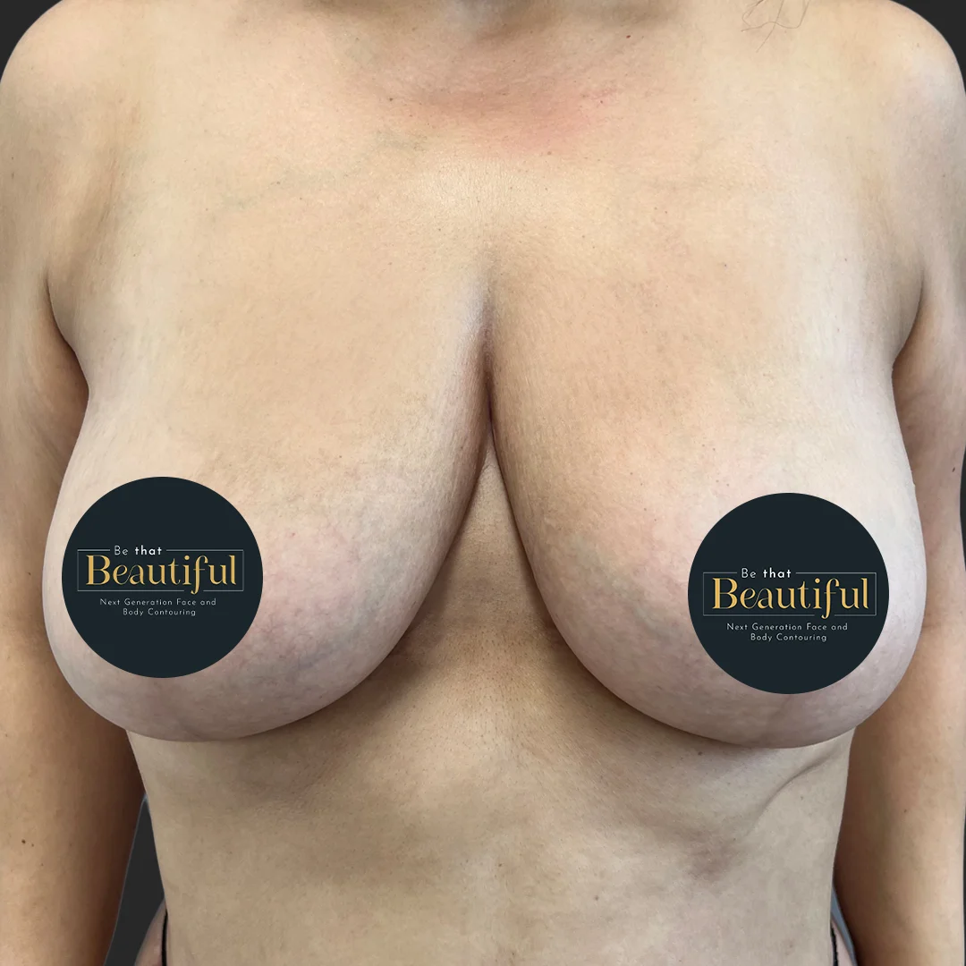 Procedure before and after - after