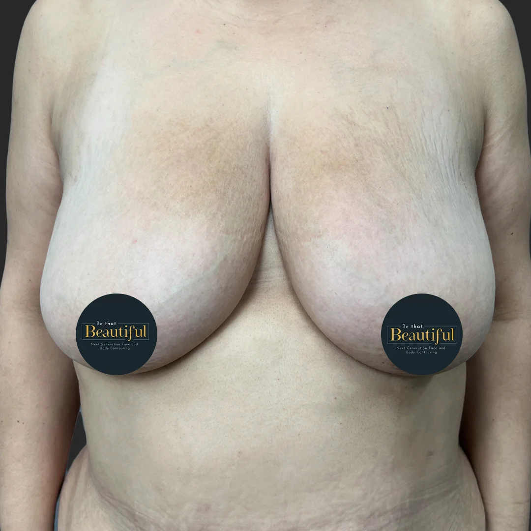Procedure before and after - before
