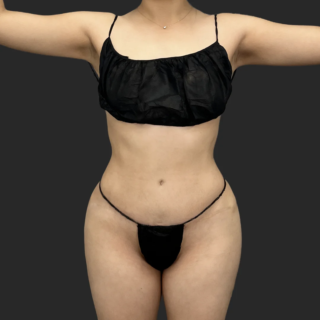 Procedure before and after - after