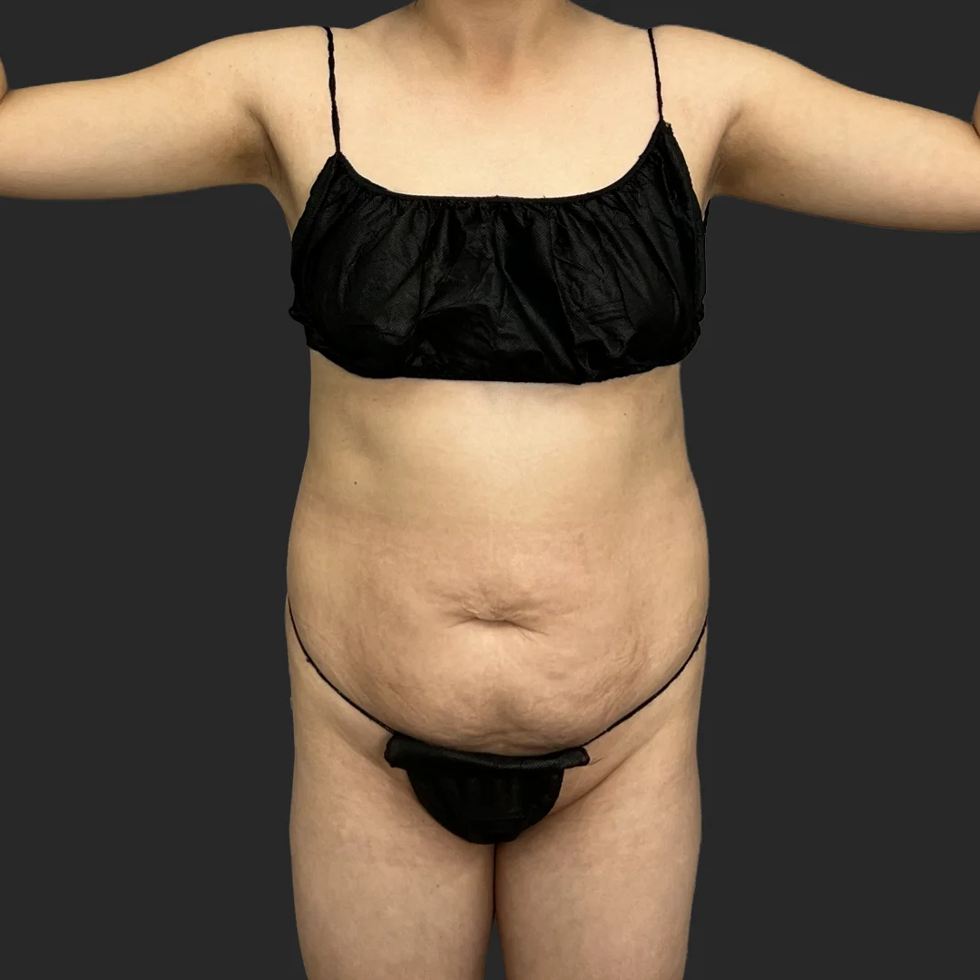 Procedure before and after - before