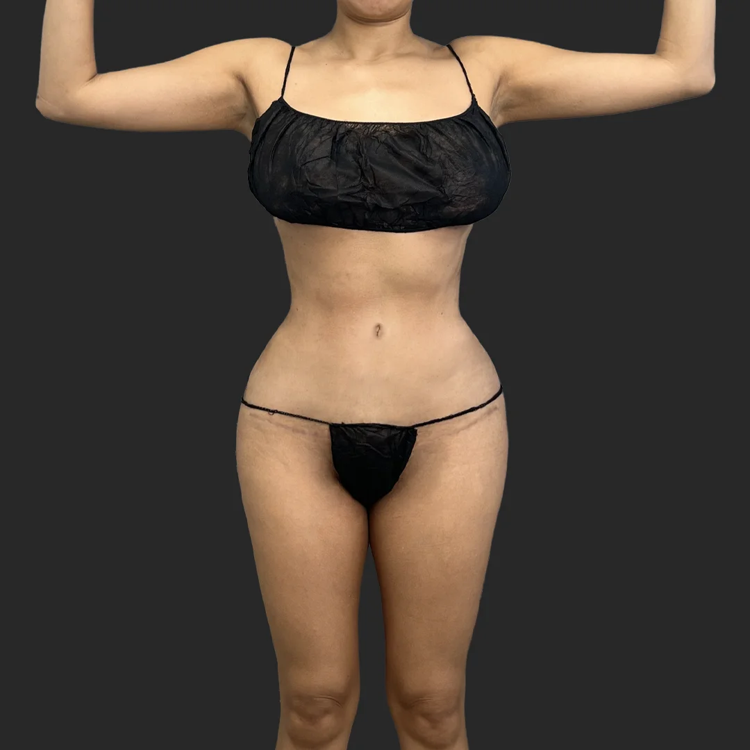 Procedure before and after - after