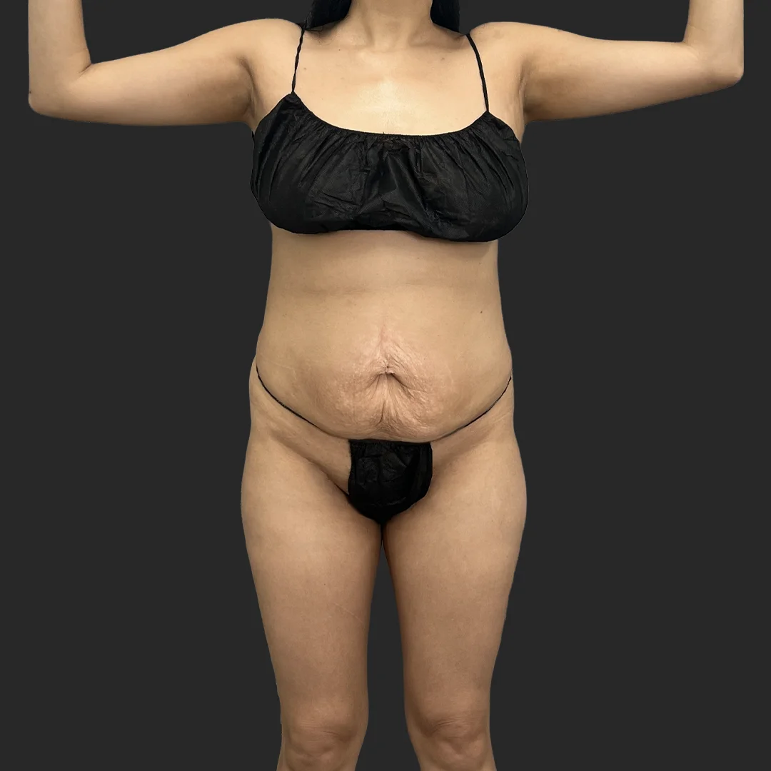 Procedure before and after - before