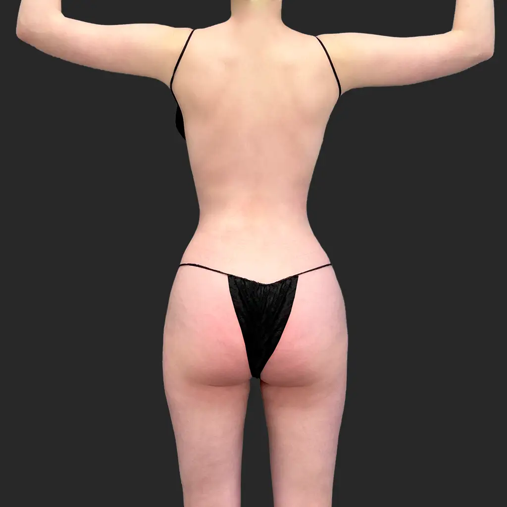 Tummy Tuck before and after - after