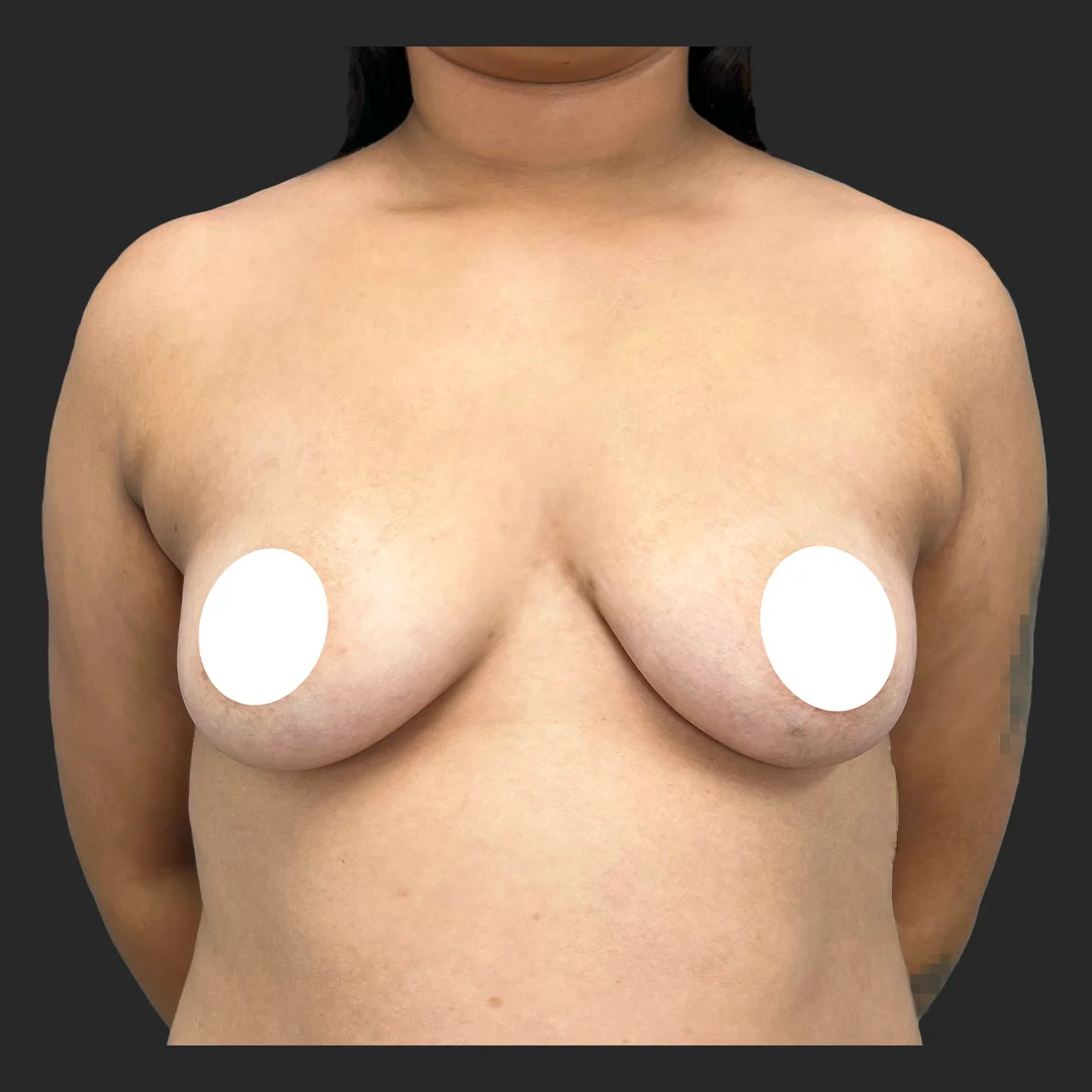 Procedure before and after - before