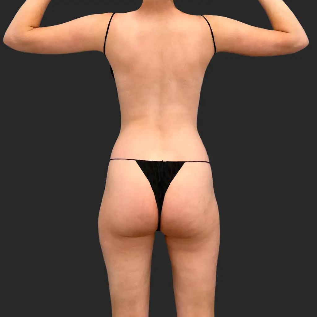 Tummy Tuck before and after - before