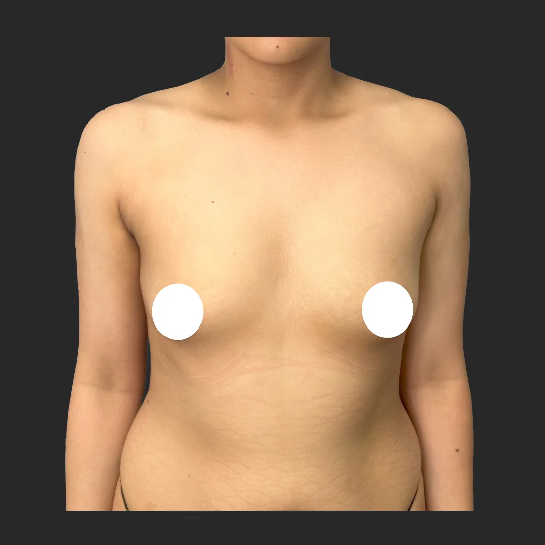 Procedure before and after - before