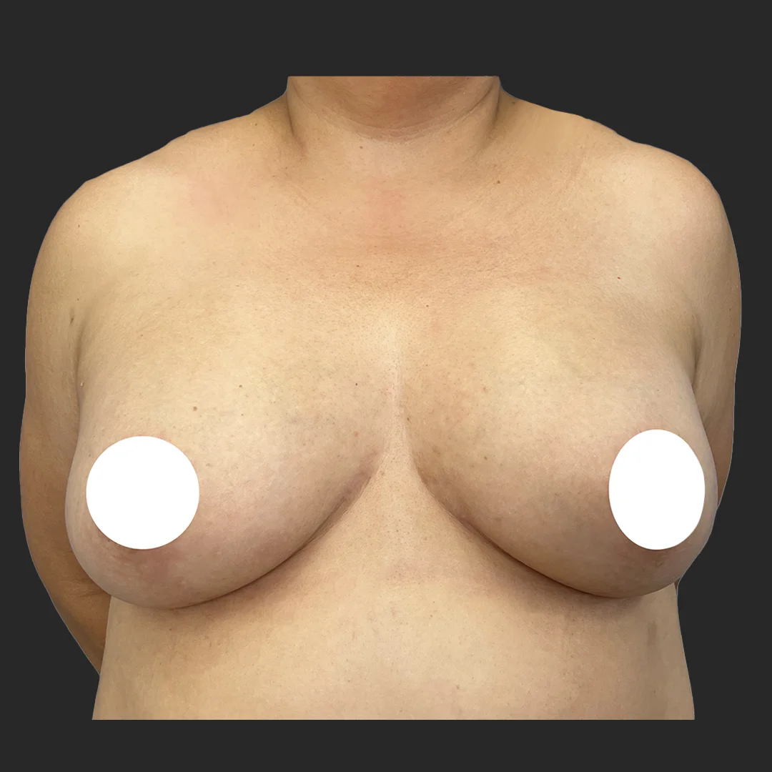 Procedure before and after - after