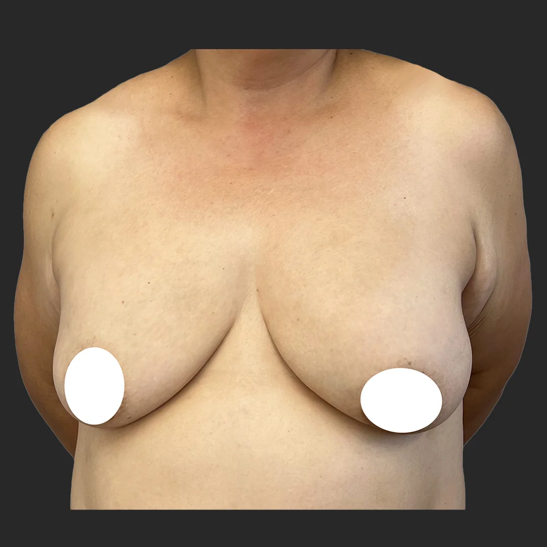 Procedure before and after - before