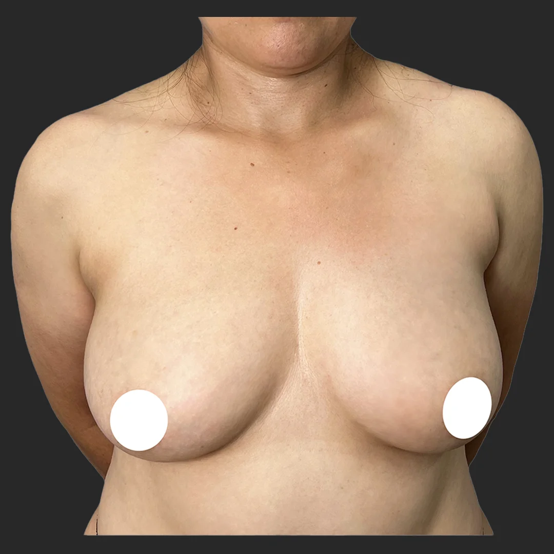 Procedure before and after - before