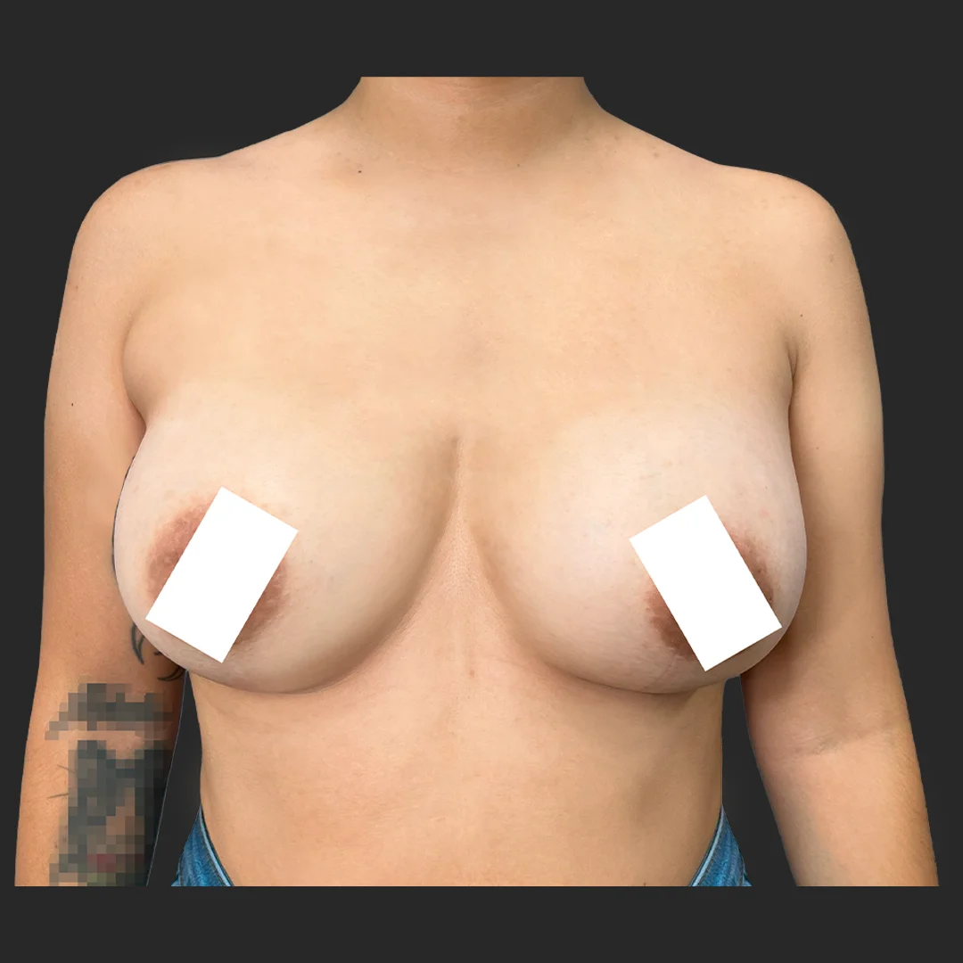 Procedure before and after - after