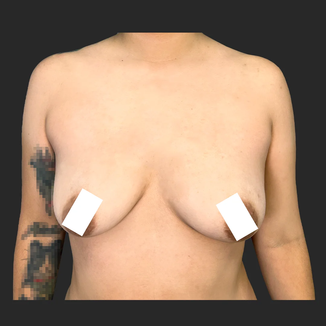 Procedure before and after - before