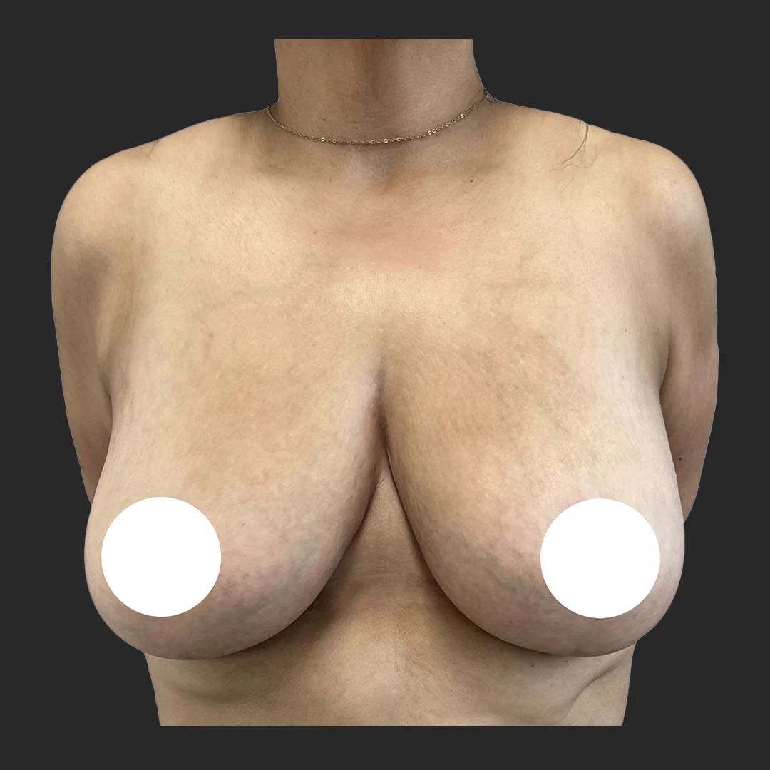 Procedure before and after - after