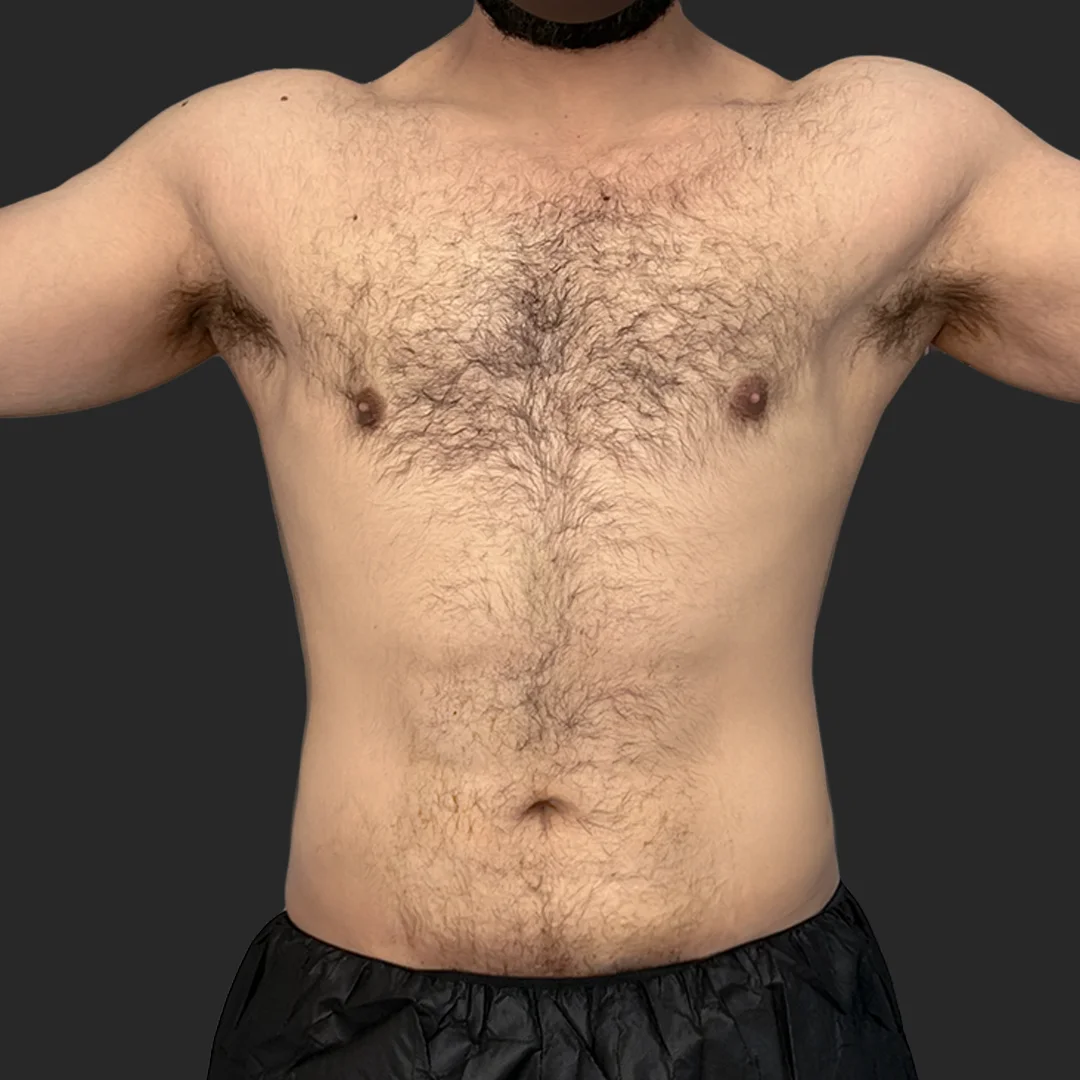 Procedure before and after - after
