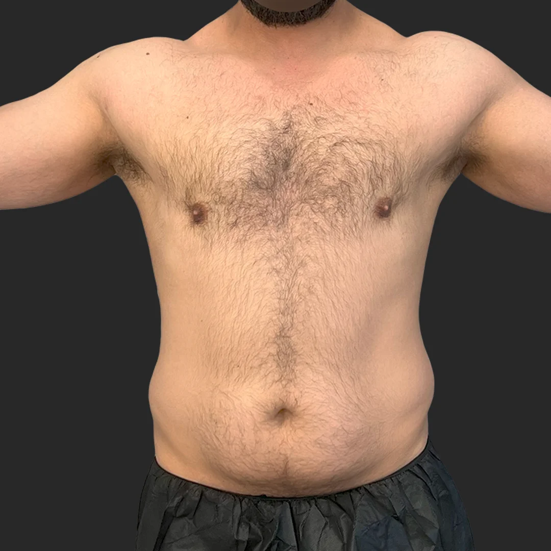 Procedure before and after - before