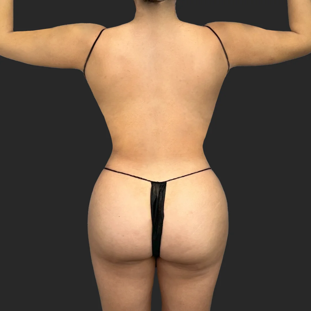 Bbl before and after - after
