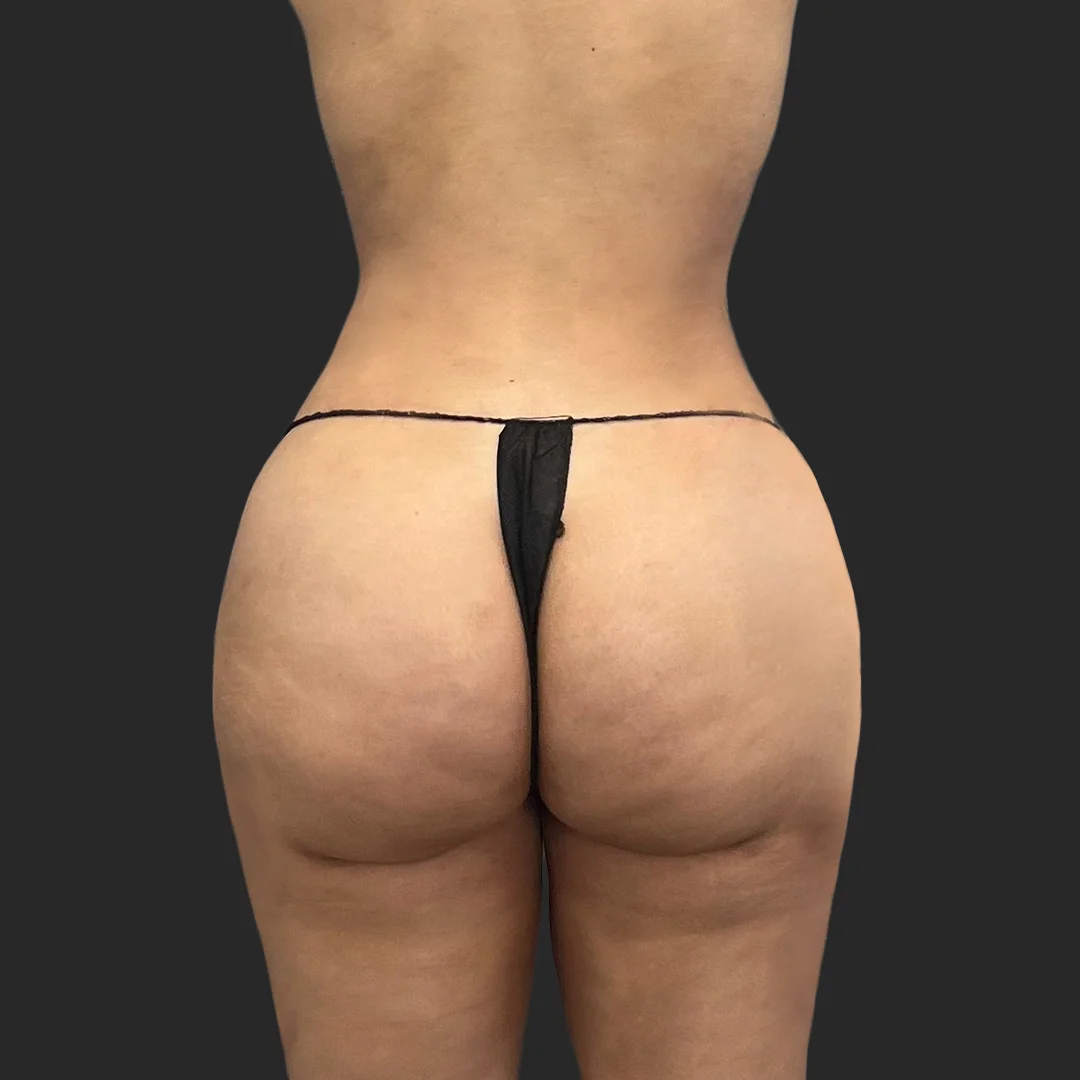 Procedure before and after - after