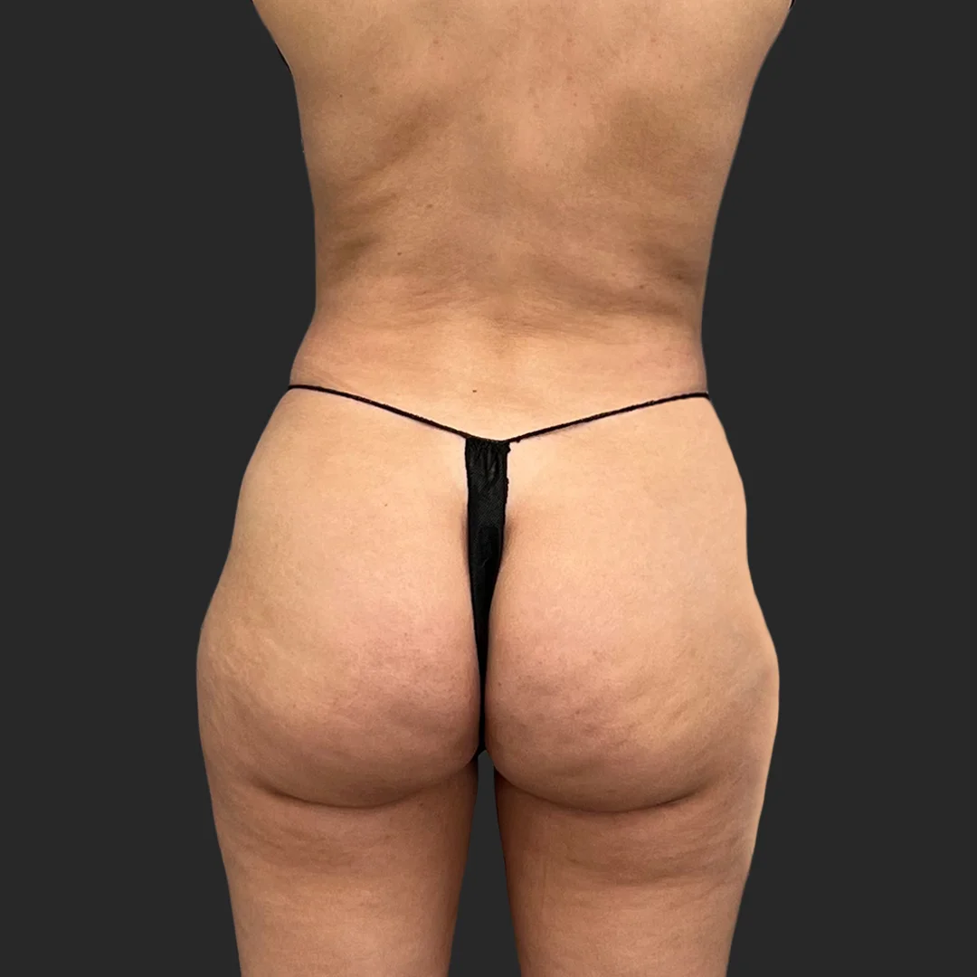 Procedure before and after - before