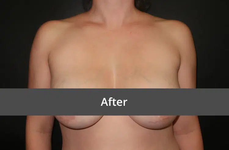 Breast Revision before and after - after