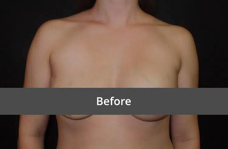 Breast Revision before and after - before
