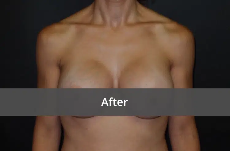 Breast Augmentation before and after - after