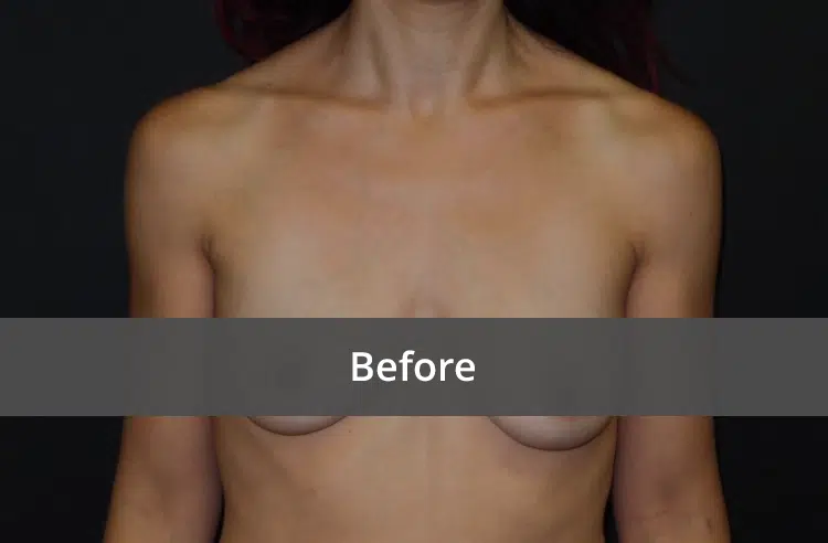 Breast Augmentation before and after - before