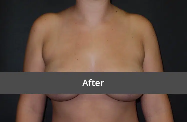 Breast Lift before and after - after