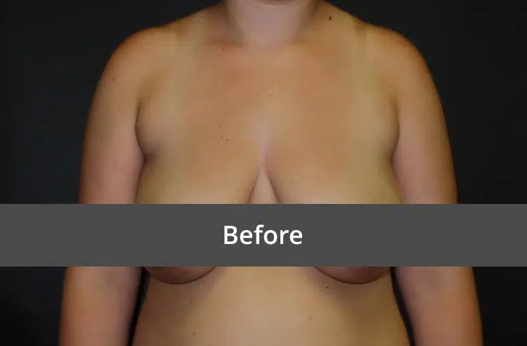 Breast Lift before and after - before