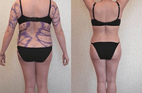 Liposuction Only before and after - after