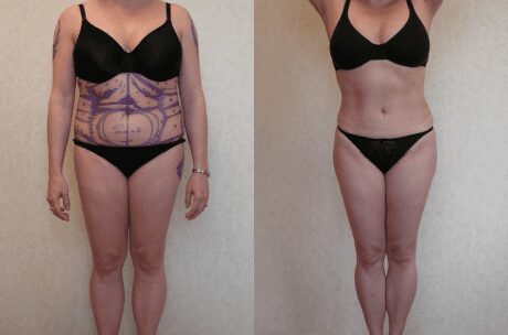 Liposuction Only before and after - before