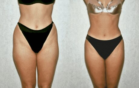 Liposuction Only before and after - after