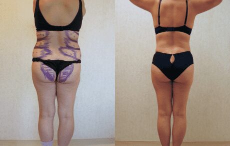 Liposuction Only before and after - before