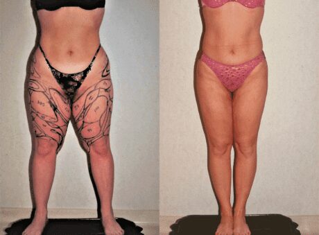 Liposuction Only before and after - after